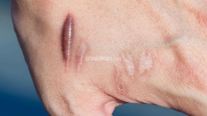 Cách dùng cây xương khỉ trong bài thuốc hỗ trợ điều trị lở loét, sẹo lồi, hạn chế mụn