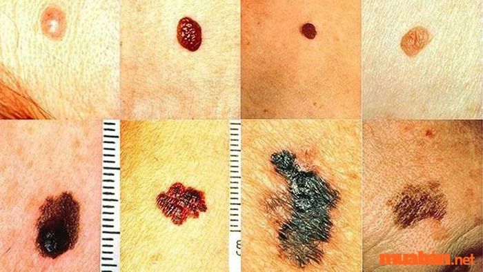 Nốt ruồi có lông mọc lên