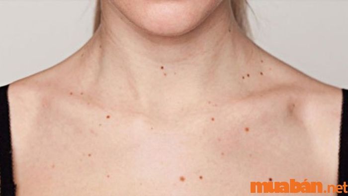 Khi xuất hiện quá nhiều nốt ruồi trên cổ
