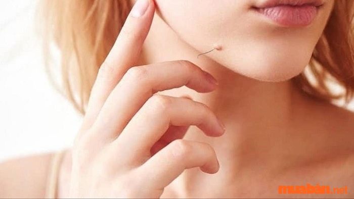 Nốt ruồi có lông