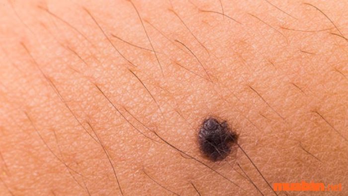 Nốt ruồi có lông mọc lên