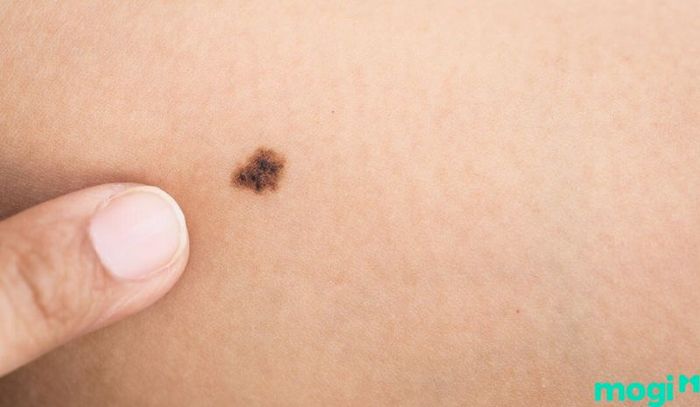 Trước khi quyết định tẩy xóa nốt ruồi ở đầu gối, bạn cần phải cân nhắc kỹ lưỡng và tham khảo lời khuyên từ các chuyên gia để đưa ra lựa chọn đúng đắn.