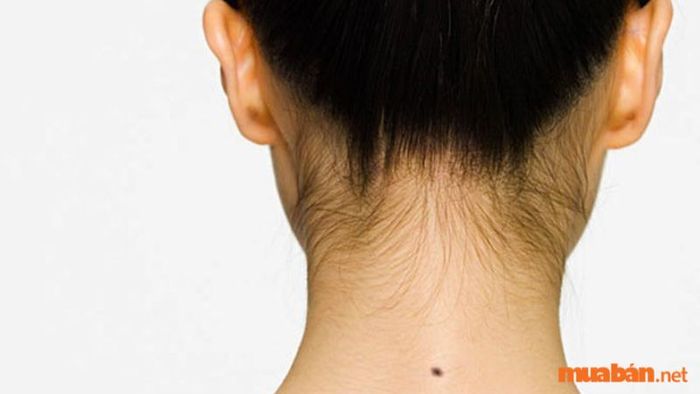 Nốt ruồi sau cổ