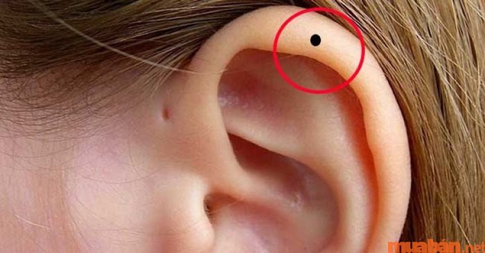 Có nên tẩy xóa nốt ruồi ở vành tai không?