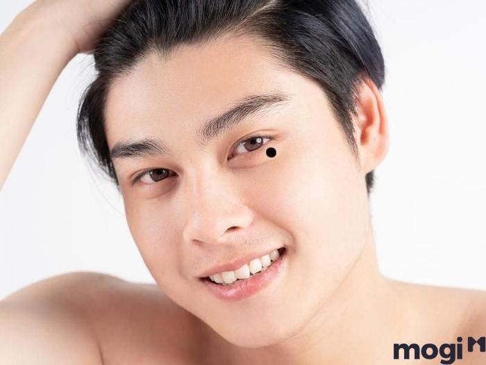 Nốt ruồi xuất hiện dưới bọng mắt của đàn ông