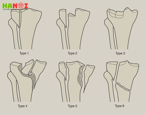 Các cấp độ vỡ mâm chày thường gặp