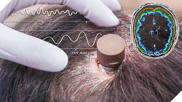 Elon Musk dự đoán về tiến trình phát triển cấy ghép chip não người trong 20 năm tới, phần 2