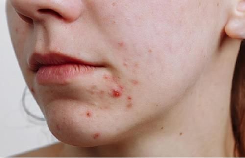 Cằm có mụn hoặc bị thương