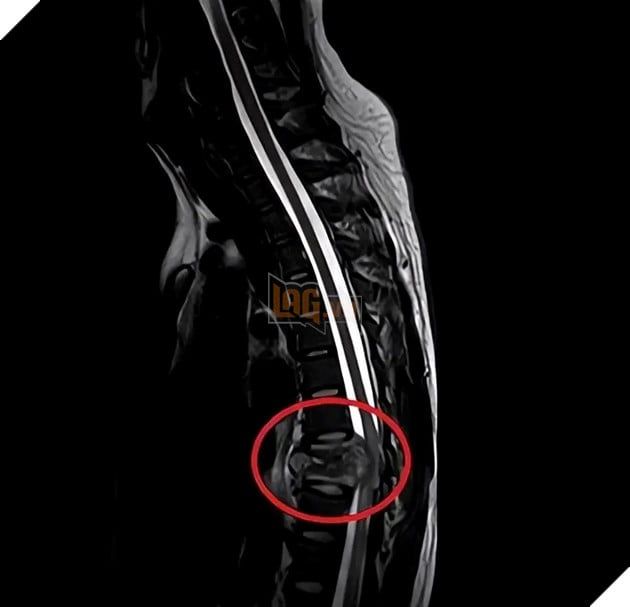 Một game thủ suýt phải đối diện với nguy cơ liệt tứ chi chỉ vì thói quen ngồi chơi net hơn 10 giờ mỗi ngày