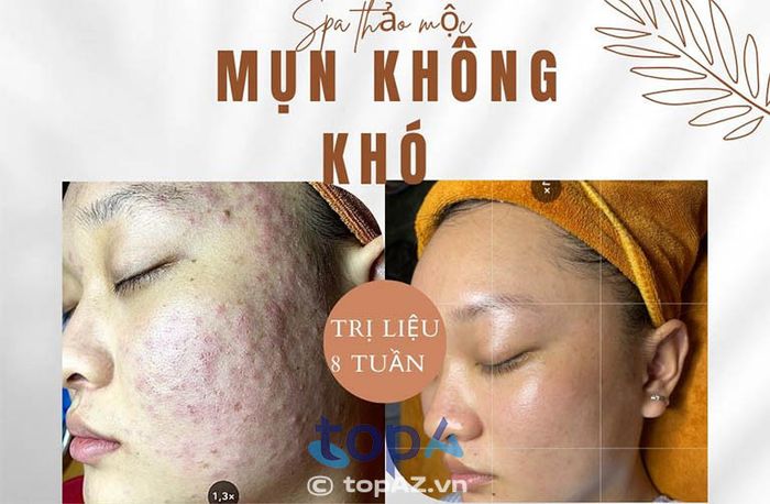 Thảo Mộc Spa – Địa chỉ trị mụn và làm đẹp uy tín tại Vị Thanh