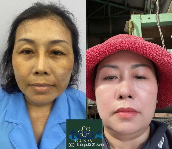 Doctor Nám – Địa chỉ uy tín chuyên điều trị nám, tàn nhang tại Dĩ An
