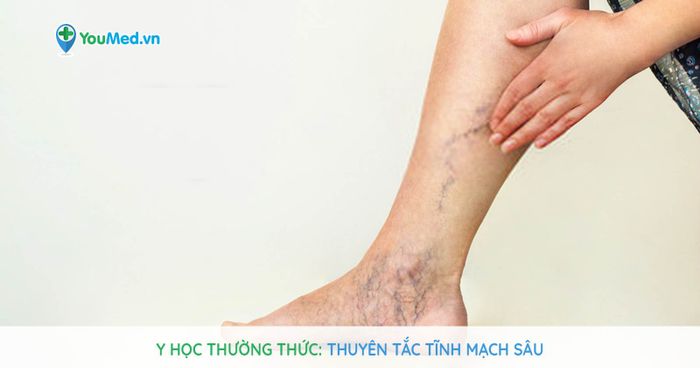 Pain and Heaviness in the Calf with Swelling in the Foot Image 1