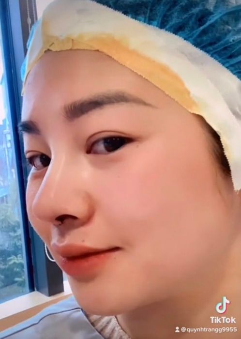 Customer's Impressions After Rhinoplasty at Dr. Hoang Tuan Aesthetic Clinic (No. 1) Image 1