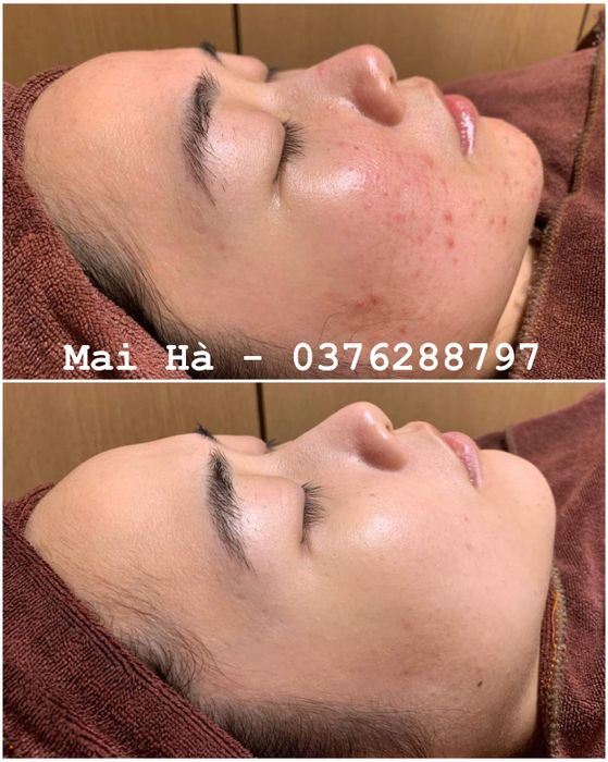 Mai Hà (Acne Treatment) Image 2