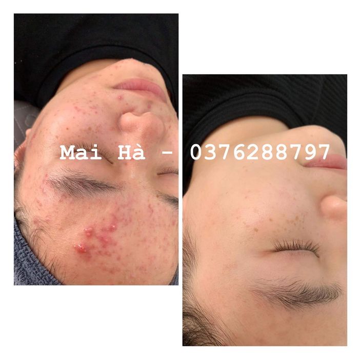 Mai Hà (Acne Treatment) Image 1