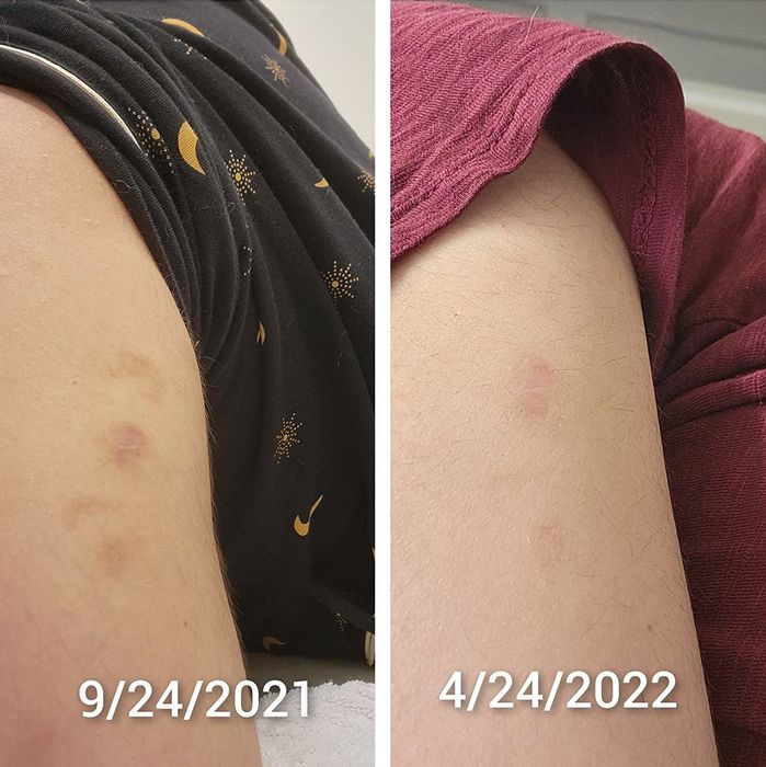 Reviewer's arm showing dark scars on