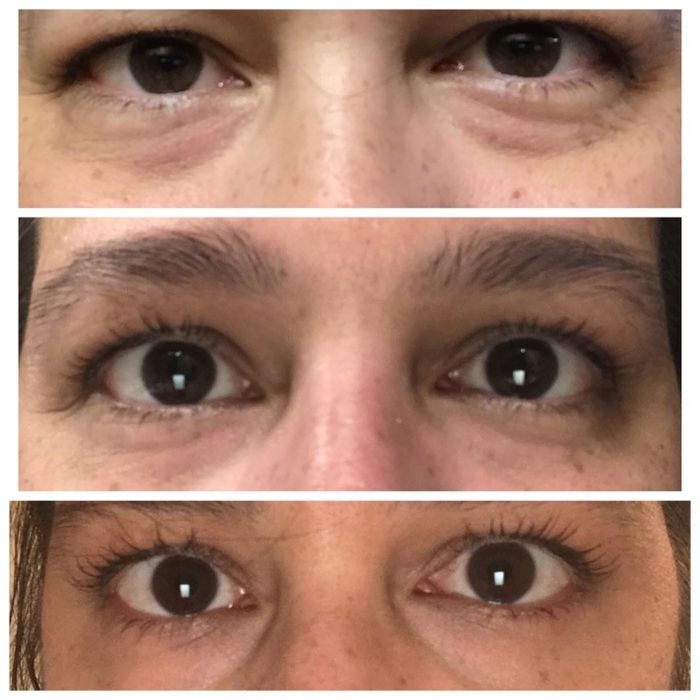 A reviewer's before and after photos using the eye cream, showcasing reduced puffiness and faded dark circles.