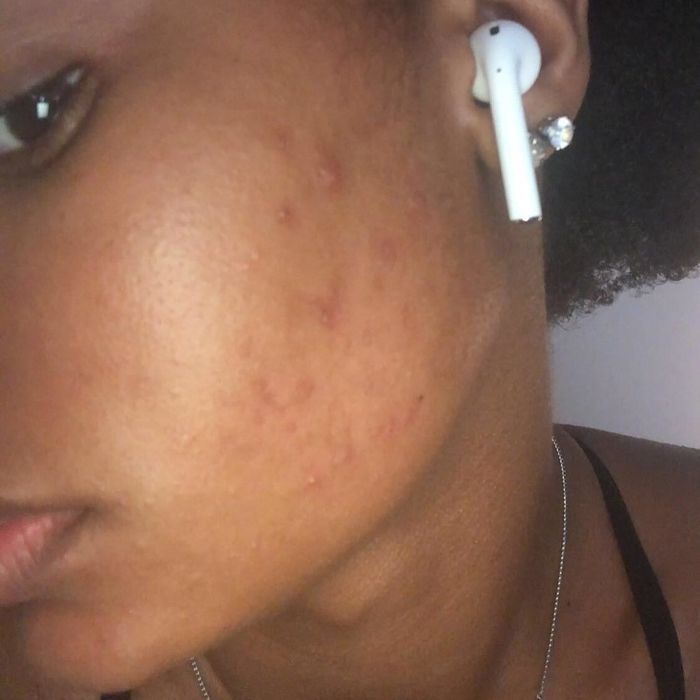 the same reviewer whose cheek acne has significantly improved, looking much calmer and less irritated