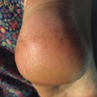 the same reviewer’s heel now smooth and clean