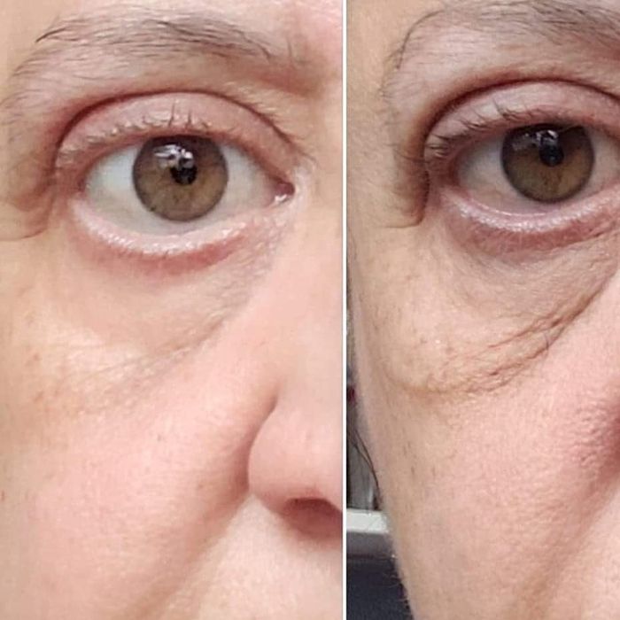 Reviewer showing a before and after of how the eye cream reduced puffiness and dark circles.