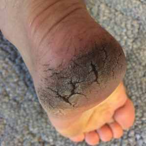 a reviewer’s cracked, rough heel