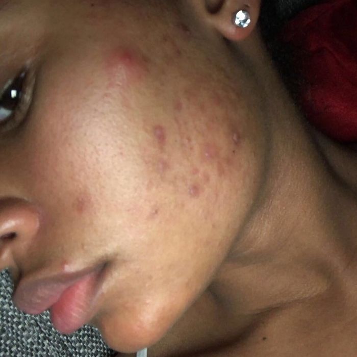 reviewer with irritated breakouts on their cheek