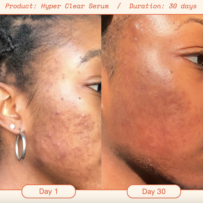 Here are before and after photos from a user after 30 days of using Hyper serum.
