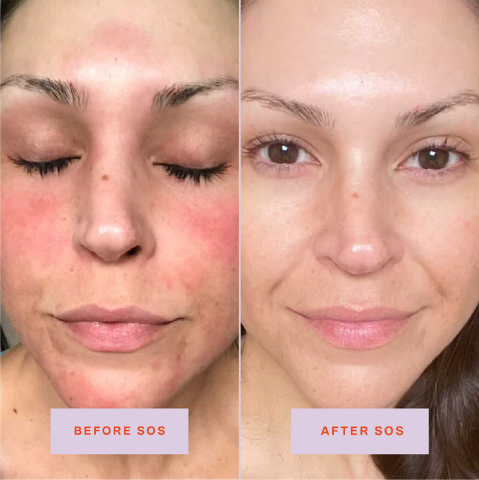 A before-and-after image showing a person with inflamed skin, followed by a smooth and even skin tone after use.