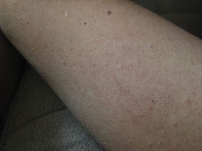 A reviewer&rsquo;s dry, rough skin before use