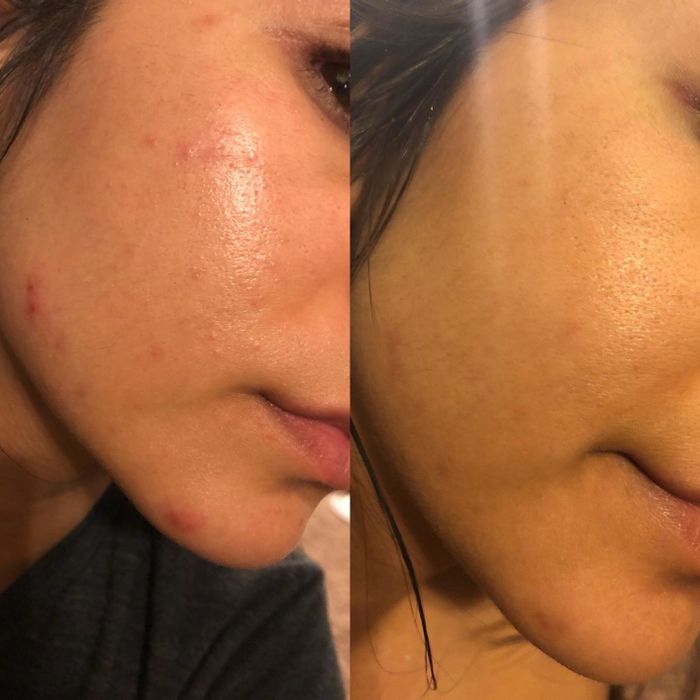A before photo of a user with inflamed, red breakouts and an after photo showing significantly clearer skin with a more even tone