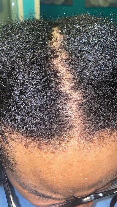 same reviewer now completely dandruff-free