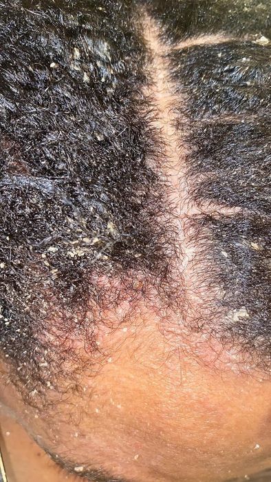 reviewer struggling with widespread dandruff