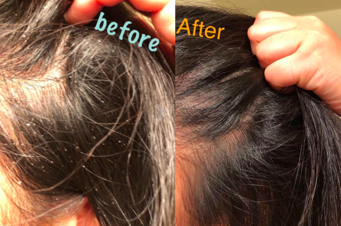 A customer photo showing the before and after results on their scalp after using the shampoo