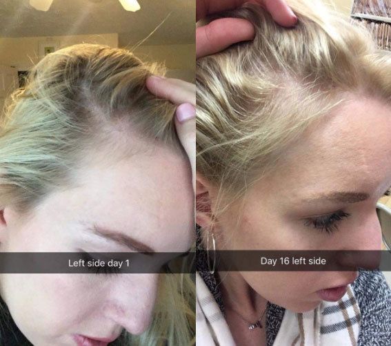 A before and after photo comparing day 1 to day 16, with the second image showing noticeable hair growth