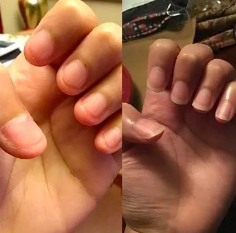 Reviewer's before and after photos: nails bitten down to swollen fingertips before, and long, healthy nails after use
