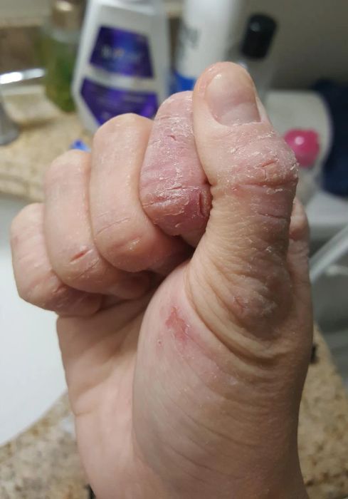 Before photo of a reviewer's hand with eczema