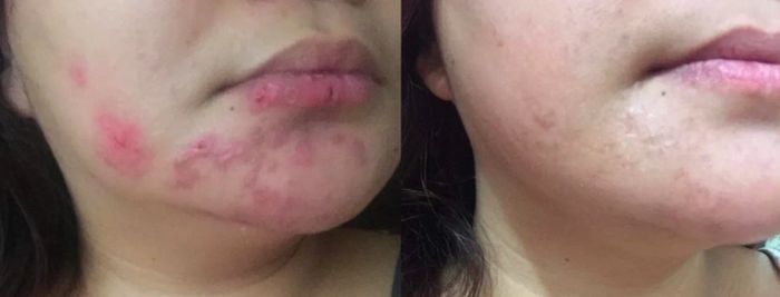 A customer's review photo displaying their skin transformation from acne-prone to clear after using the oil