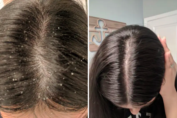 A before-and-after comparison: one image showing a scalp with dandruff and the other revealing a clean, dandruff-free scalp