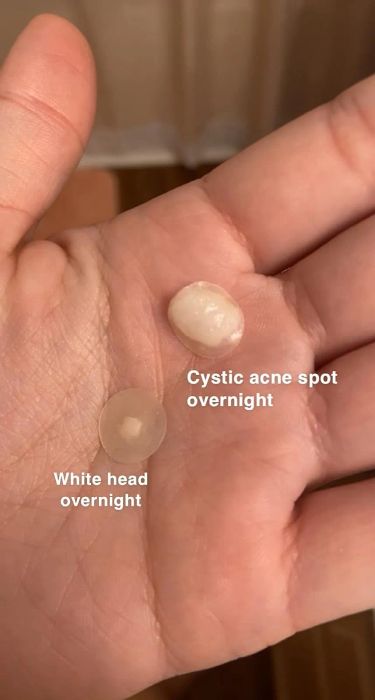 Reviewer holding two used pimple patches: one applied to a whitehead and the other on cystic acne