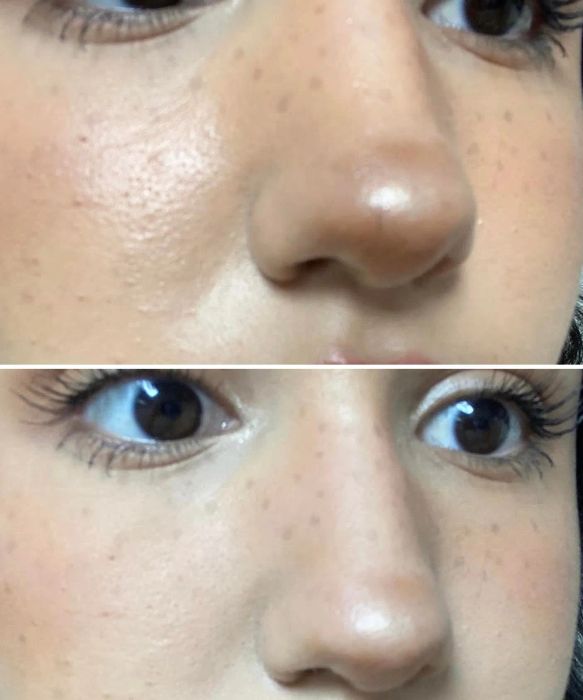 Reviewer's before and after photos: oily T-zone before using the roller and a matte T-zone after using it