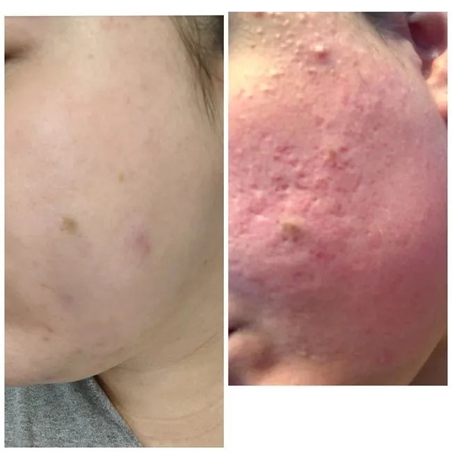 A reviewer's before and after photos showing reduced redness, texture, acne, and scarring