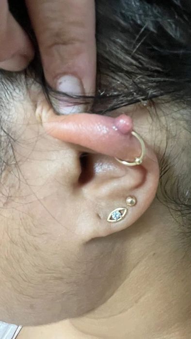 Reviewer's ear showing a keloid bump on their piercing