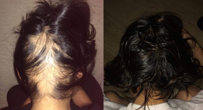 A reviewer’s before photo displaying balding spots on their scalp, followed by an after photo showing noticeable new hair growth in the same area