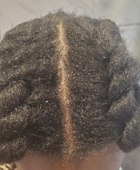 Reviewer photo of scalp with dandruff.