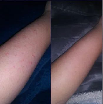Before and after photo of a reviewer’s arm showing bumps before and smooth skin after using the scrub