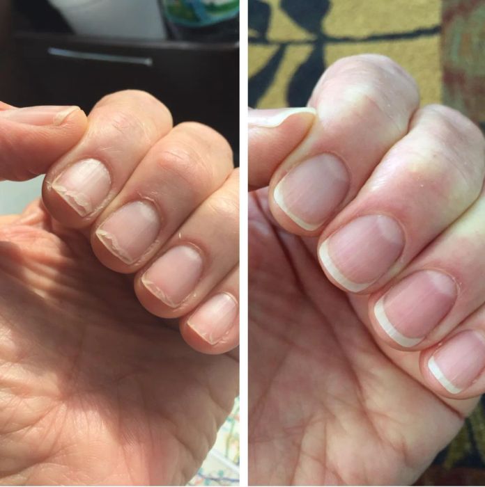 Reviewer's before photo showing peeling, weak nails and after photo with strong, healthy nails after using the oil