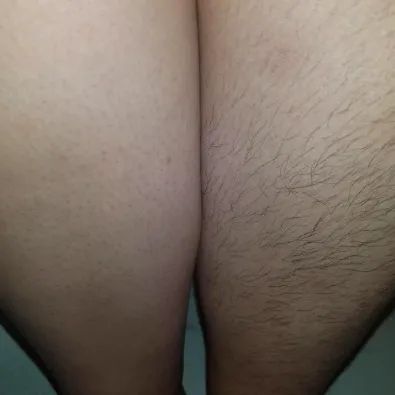 A reviewer showing one hairy upper thigh and the other freshly shaved using the product