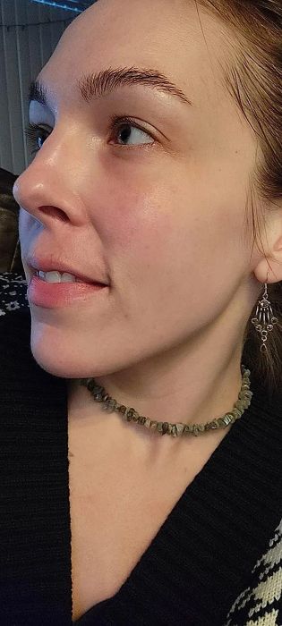 Reviewer's after photo with redness visibly reduced after using the toner
