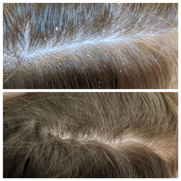 Before and after photos from a reviewer showing scalp buildup on top and a clean, refreshed scalp below