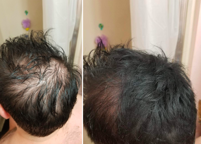 A reviewer's before and after photos demonstrating the use of hair-building fibers to effectively conceal bald spots